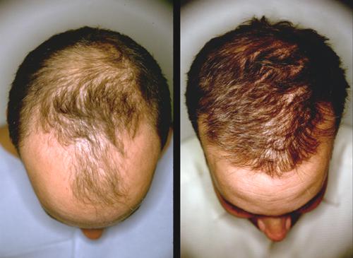 is it possible to regrow hair on crown naturally